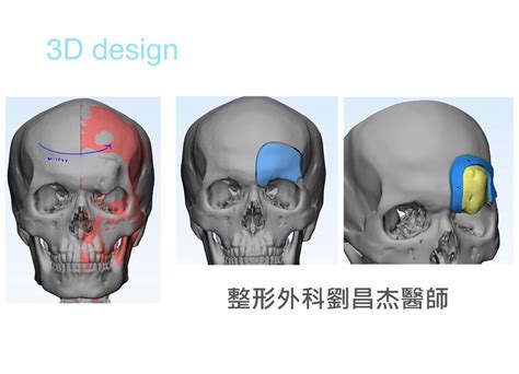 剃雉技術|降低顱骨重建手術部位感染率 之專案